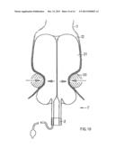 Closing system for a natural or artificial anus diagram and image
