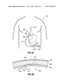 REMOTELY ADJUSTABLE GASTRIC BANDING SYSTEM diagram and image