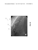 Methods and Systems for Determining Vascular Bodily Lumen Information and     Guiding Medical Devices diagram and image