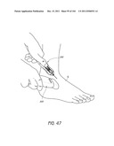 REMOVABLE CASSETTE FOR ARTICULAR INJECTION SYSTEM diagram and image