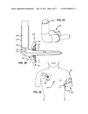 SELF-SEALING DEVICE AND METHOD FOR DELIVERY OF A THERAPEUTIC AGENT THROUGH     A PNEUMOSTOMA diagram and image