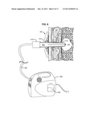 SELF-SEALING DEVICE AND METHOD FOR DELIVERY OF A THERAPEUTIC AGENT THROUGH     A PNEUMOSTOMA diagram and image