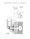 SELF-SEALING DEVICE AND METHOD FOR DELIVERY OF A THERAPEUTIC AGENT THROUGH     A PNEUMOSTOMA diagram and image