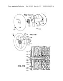 SELF-SEALING DEVICE AND METHOD FOR DELIVERY OF A THERAPEUTIC AGENT THROUGH     A PNEUMOSTOMA diagram and image