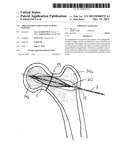 ARRANGEMENT FOR INTERNAL BONE SUPPORT diagram and image