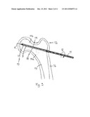 ARRANGEMENT FOR INTERNAL BONE SUPPORT diagram and image