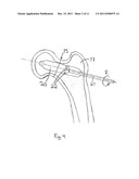 ARRANGEMENT FOR INTERNAL BONE SUPPORT diagram and image