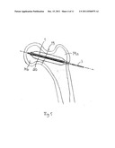 ARRANGEMENT FOR INTERNAL BONE SUPPORT diagram and image