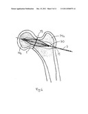 ARRANGEMENT FOR INTERNAL BONE SUPPORT diagram and image