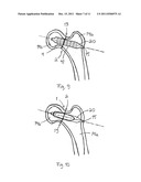 ARRANGEMENT FOR INTERNAL BONE SUPPORT diagram and image