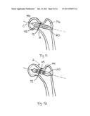 ARRANGEMENT FOR INTERNAL BONE SUPPORT diagram and image