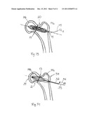 ARRANGEMENT FOR INTERNAL BONE SUPPORT diagram and image