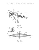 ARRANGEMENT FOR INTERNAL BONE SUPPORT diagram and image