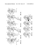 METHODS AND APPARATUS FOR ACETABULAR ARTHROPLASTY diagram and image