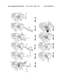 METHODS AND APPARATUS FOR ACETABULAR ARTHROPLASTY diagram and image