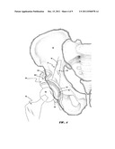 METHODS AND APPARATUS FOR ACETABULAR ARTHROPLASTY diagram and image