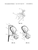 METHODS AND APPARATUS FOR ACETABULAR ARTHROPLASTY diagram and image