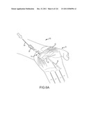 SYSTEMS AND METHODS FOR TREATMENT OF COMPRESSED NERVES diagram and image