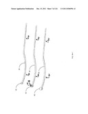 SYSTEMS AND METHODS FOR TREATMENT OF COMPRESSED NERVES diagram and image