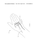 SYSTEMS AND METHODS FOR TREATMENT OF COMPRESSED NERVES diagram and image