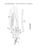 SYSTEMS AND METHODS FOR TREATMENT OF COMPRESSED NERVES diagram and image