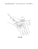 SYSTEMS AND METHODS FOR TREATMENT OF COMPRESSED NERVES diagram and image