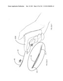 SYSTEMS AND METHODS FOR TREATMENT OF COMPRESSED NERVES diagram and image