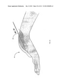 SYSTEMS AND METHODS FOR TREATMENT OF COMPRESSED NERVES diagram and image