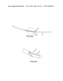 SYSTEMS AND METHODS FOR TREATMENT OF COMPRESSED NERVES diagram and image