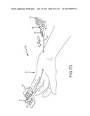 SYSTEMS AND METHODS FOR TREATMENT OF COMPRESSED NERVES diagram and image