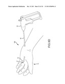 SYSTEMS AND METHODS FOR TREATMENT OF COMPRESSED NERVES diagram and image