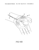 SYSTEMS AND METHODS FOR TREATMENT OF COMPRESSED NERVES diagram and image