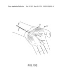 SYSTEMS AND METHODS FOR TREATMENT OF COMPRESSED NERVES diagram and image