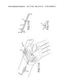 SYSTEMS AND METHODS FOR TREATMENT OF COMPRESSED NERVES diagram and image