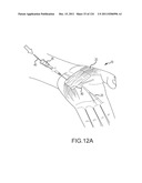 SYSTEMS AND METHODS FOR TREATMENT OF COMPRESSED NERVES diagram and image