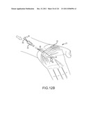 SYSTEMS AND METHODS FOR TREATMENT OF COMPRESSED NERVES diagram and image