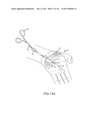 SYSTEMS AND METHODS FOR TREATMENT OF COMPRESSED NERVES diagram and image