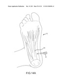 SYSTEMS AND METHODS FOR TREATMENT OF COMPRESSED NERVES diagram and image