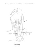 SYSTEMS AND METHODS FOR TREATMENT OF COMPRESSED NERVES diagram and image