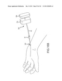 SYSTEMS AND METHODS FOR TREATMENT OF COMPRESSED NERVES diagram and image