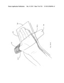 SYSTEMS AND METHODS FOR TREATMENT OF COMPRESSED NERVES diagram and image