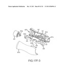 SYSTEMS AND METHODS FOR TREATMENT OF COMPRESSED NERVES diagram and image