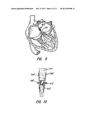 PERCUTANEOUS CATHETER DIRECTED INTRAVASCULAR OCCLUSION DEVICES diagram and image
