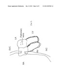 SYSTEMS AND METHODS FOR PREVENTING FORMATION OF BLOOD CLOTS IN THE LEFT     ATRIUM diagram and image