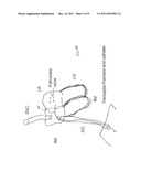 SYSTEMS AND METHODS FOR PREVENTING FORMATION OF BLOOD CLOTS IN THE LEFT     ATRIUM diagram and image