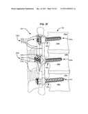 ADAPTIVE SPINAL ROD AND METHODS FOR STABILIZATION OF THE SPINE diagram and image