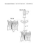 ADAPTIVE SPINAL ROD AND METHODS FOR STABILIZATION OF THE SPINE diagram and image