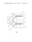 DYNAMIC SPINAL STABILIZATION ASSEMBLY WITH SLIDING COLLARS diagram and image