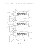 DYNAMIC SPINAL STABILIZATION ASSEMBLY WITH SLIDING COLLARS diagram and image