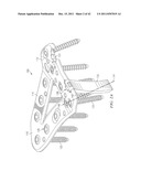 System for Treating Bone Fractures diagram and image